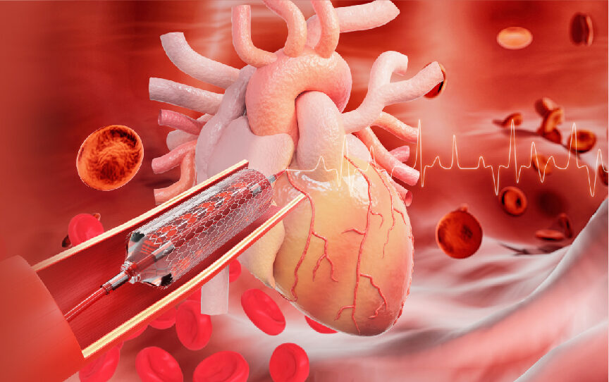 6762be63dbbc5Large-ischemic-heart-disease-symptoms-types-and-effective-treatments